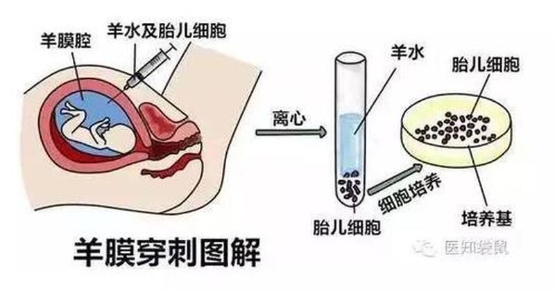 羊水DNA检测，揭秘算命胎儿的准确性